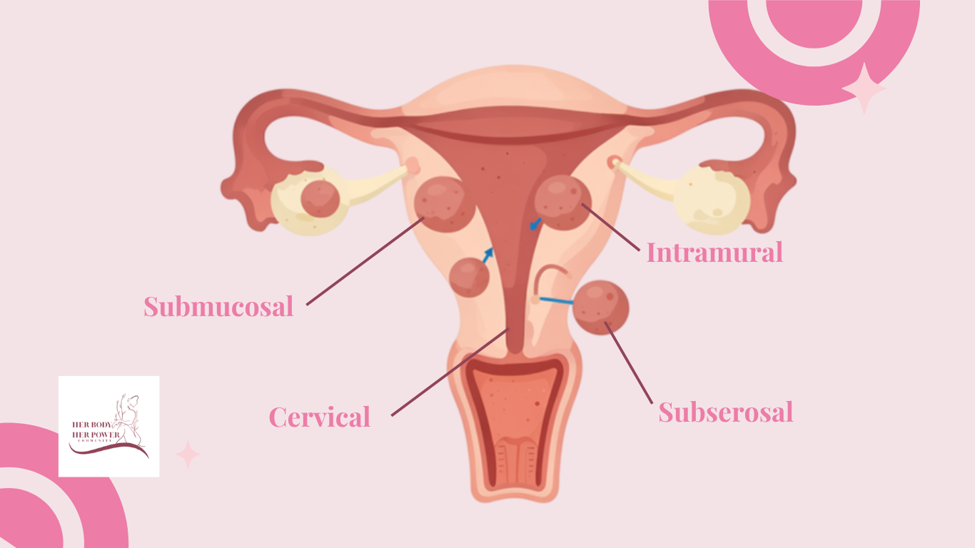 An anatomical diagram illustration of a uterus labeling where submucosal, intramural, cervical, and subserosal fibroids grow.